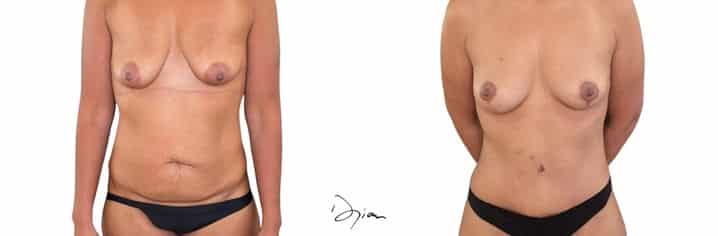 Mommy makeover 3 avant après