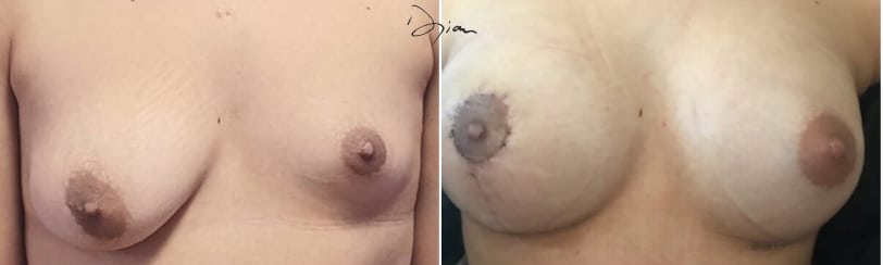 Seins asymétrique
