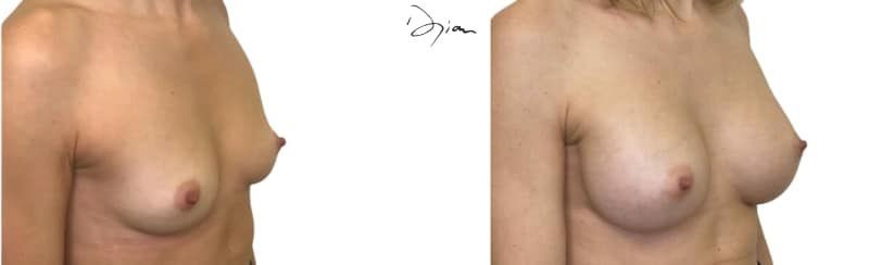 seins en forme de poire