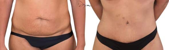 before after mini abdominoplasty