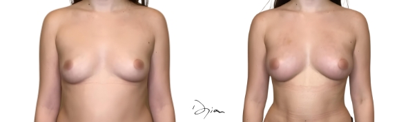 lipofilling mammaire