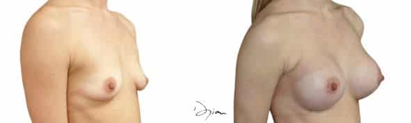 Augmentation mammaire après grossesse