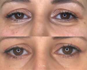 Avant apres injection des cernes