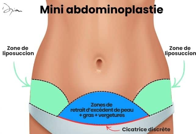 Zone incision mini abdomonoplastie