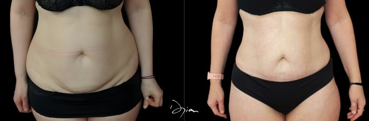 liposuccion du ventre et minilifting abdominal