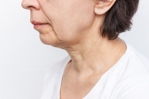 Voir Comment corriger un menton fuyant sans (ou avec) chirurgie ?