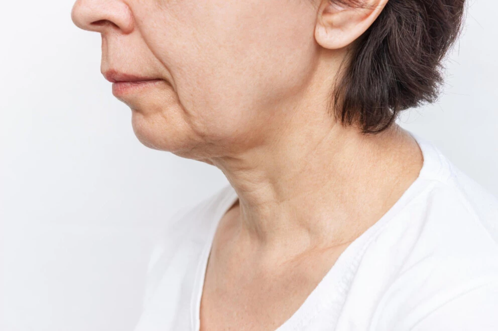 Comment corriger un menton fuyant sans (ou avec) chirurgie ?