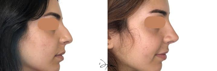 Rhinoplasty before and after