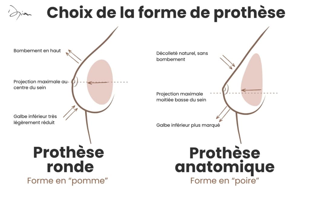 Implant rond ou anatomique