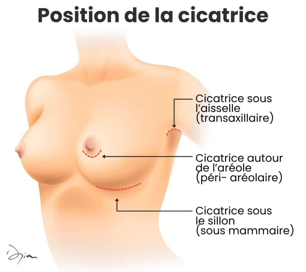 position de la cicatrice suite augmentation mammaire