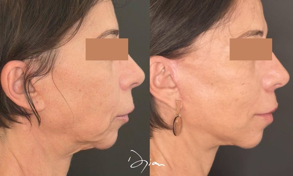 Avant apr&egrave;s Deep plan facelift profil