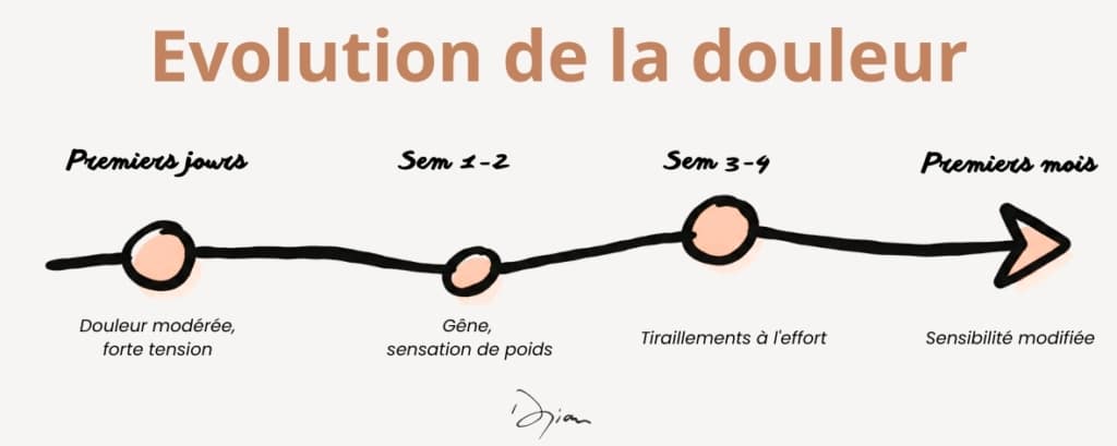 Évolution de la douleur après une augmentation mammaire